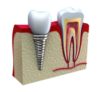 Dental implant (Diş implantı) nedir?